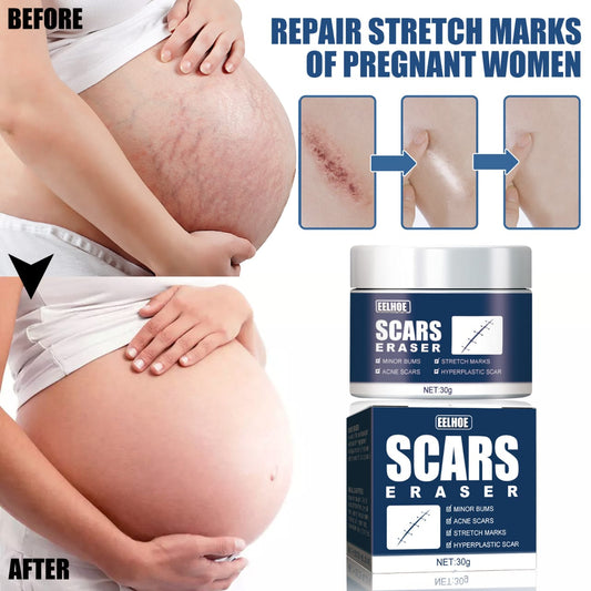 Scars, stretchmarks remover cream